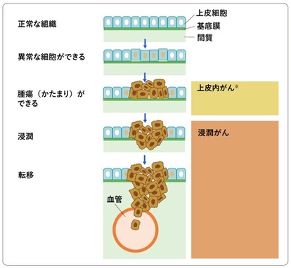 がんの発生と進行